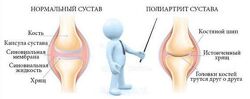 Игорь Кауфман Реаматоидный полиартрит Восстановление микробиома кишечника