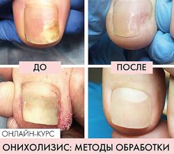 Карина Шурыгина Набор Аппаратный педикюр Онихолизис