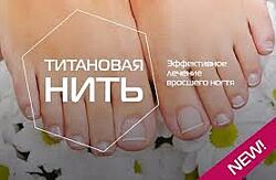 Ортониксия и установка титановой нити. Методы работы с врастающим ногтем