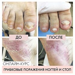  Грибковое поражение ногтей и кожи стоп Карина Шурыгина